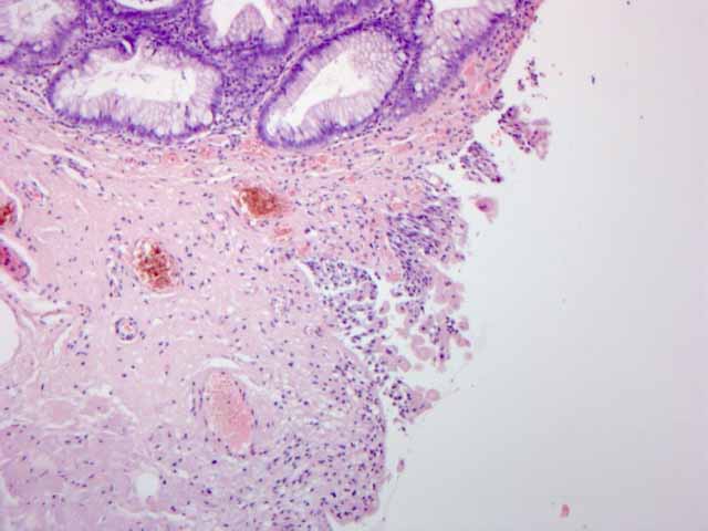 Figura 2 - Transicin de adenoma velloso con mucosa de vejiga.